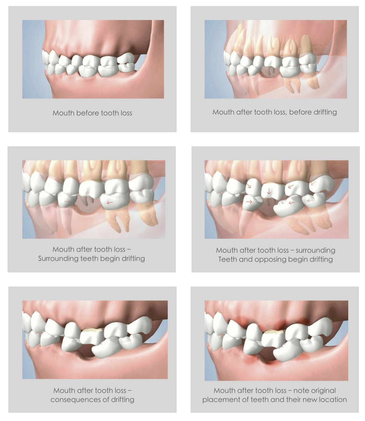 Why Replace Missing Teeth